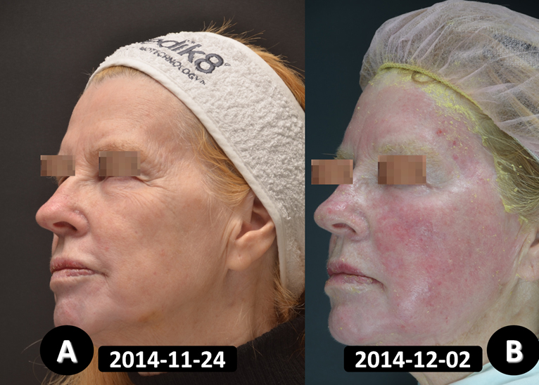 Pav.3 Pacientė 8-ą parą po giliojo cheminio pilingo procedūros kaktos ir skruostų odoje: odos raukšlėtumas išnykęs, matomas odos paraudimas (eritema).